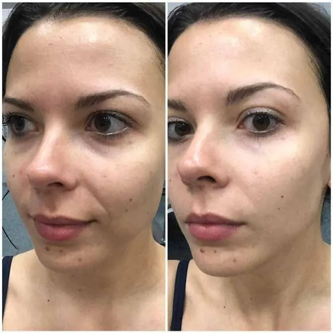 Rezultat Jordi Shape înainte și după — contur facial definit