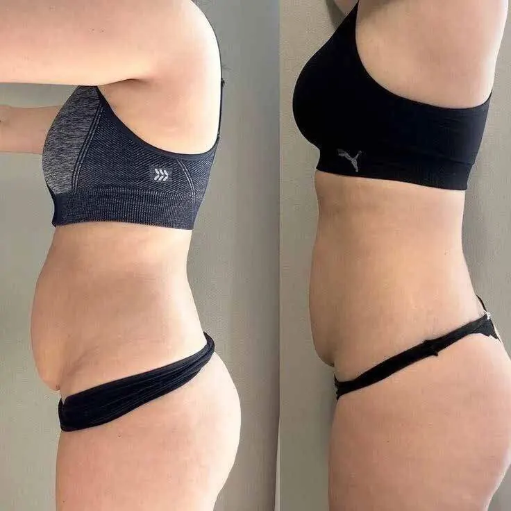 Rezultat Jordi Shape înainte și după — abdomen vedere din profil