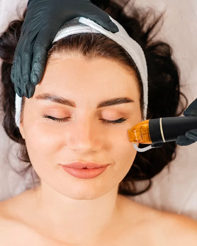 MicroRF - aplicare tratament microneedling cu radiofrecvență