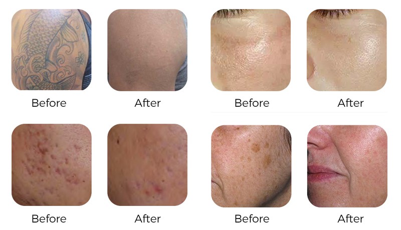 Aplicații TRUE Pico Laser - înainte și după: tatuaje, pigmentări, pete de acnee, pete de vârstă