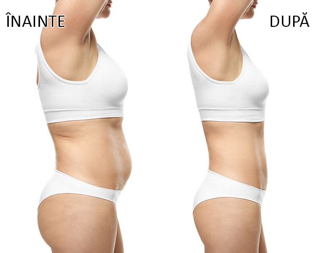 Rezultate EMSlim - reducere abdomen, vedere laterală