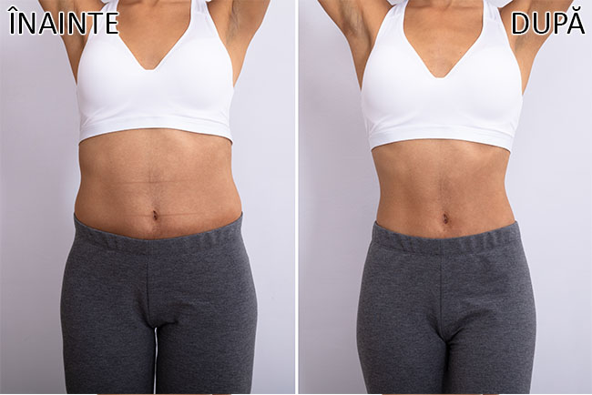 Rezultate EMSlim - tonifiere abdominală, vedere frontală