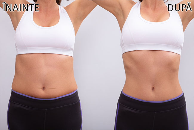 Rezultate EMSlim - definire abdomen și talie