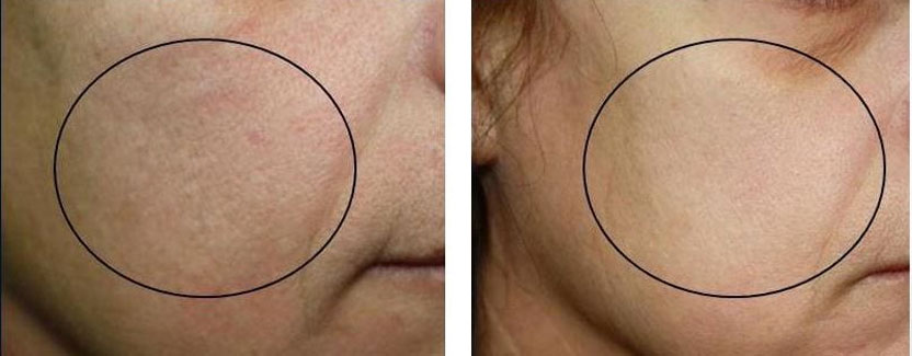 Hydrapure Oxygeneo - rezultat tratament