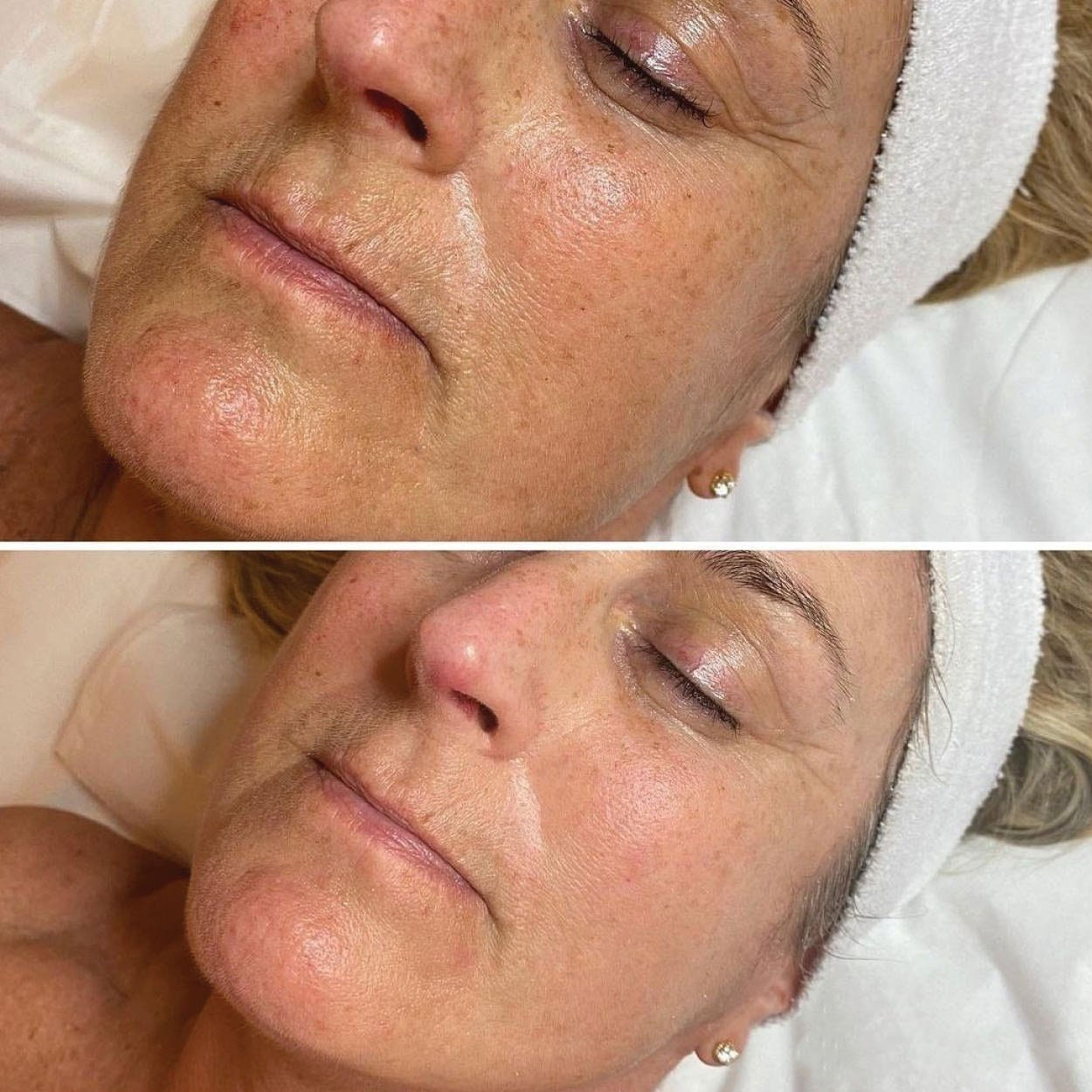 Hydrapure Oxygeneo - rezultat tratament