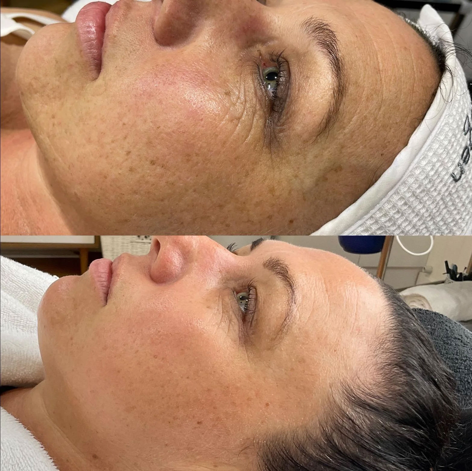 Hydrapure Oxygeneo - rezultat tratament