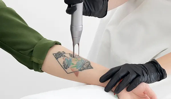 Eliminare Tatuaje